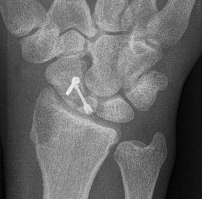 Scaphoid Proximal Pole Nonunion Bone Graft